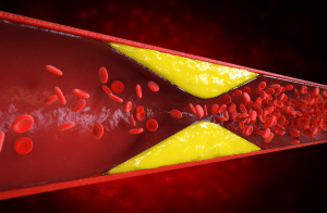 blood vessel inflammation